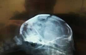Image showing an X-ray of the Kittens broken skull