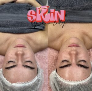 Dermaplaning and deep cleanse facial- skincare