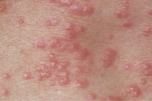 scabies case symptoms 