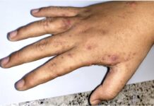 Hand covered in skin disease