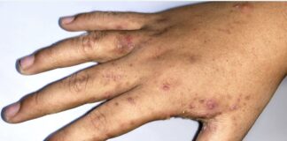 Hand covered in skin disease