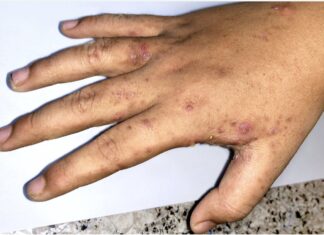 Hand covered in skin disease