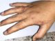 Hand covered in skin disease